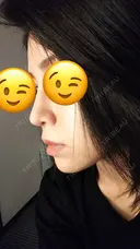 鼻尖形成（切開） / 軟骨移植 表参道スキンクリニック 表参道院 DAY 49 サムネイル用