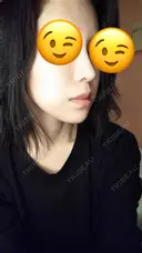 鼻尖形成（切開） / 軟骨移植 表参道スキンクリニック 表参道院 DAY 49 サムネイル用