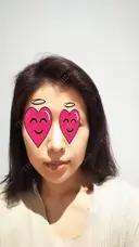 鼻尖形成（切開） / 軟骨移植 表参道スキンクリニック 表参道院 AFTER サムネイル用