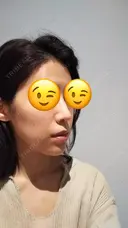 鼻尖形成（切開） / 軟骨移植 表参道スキンクリニック 表参道院 DAY 87 サムネイル用