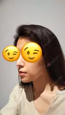 鼻尖形成（切開） / 軟骨移植 表参道スキンクリニック 表参道院 DAY 87 サムネイル用