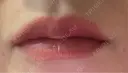 アートメイク（唇） セカジソウォン医院-明洞店 DAY 8 サムネイル用