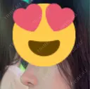 鼻尖形成（切開） / 軟骨移植 id（アイディ）美容外科 AFTER サムネイル用