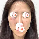 肌ヒアルロン酸注入（たるみ・シワ改善） しのぶ皮膚科 DAY 0 サムネイル用