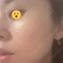 ボトックス（あご） / ボトックス（口角） / ボトックス（眉間） / ボトックス（額） / ボトックス（バニーライン） / その他（鼻） TCB東京中央美容外科 札幌駅前院 DAY 11 サムネイル用