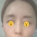 ボトックス（あご） / ボトックス（口角） / ボトックス（眉間） / ボトックス（額） / ボトックス（バニーライン） / その他（鼻） TCB東京中央美容外科 札幌駅前院 DAY 11 サムネイル用