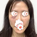 肌ヒアルロン酸注入（たるみ・シワ改善） しのぶ皮膚科 DAY 1 サムネイル用