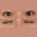 二重切開 / 眼瞼下垂（切開） / 上まぶたたるみ取り eクリニック 福岡院 DAY 21 サムネイル用