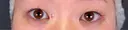 眼瞼下垂（非切開） SOL CLINIC DAY 0 サムネイル用