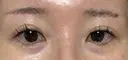 眉下切開 ノエル銀座クリニック DAY 35 サムネイル用