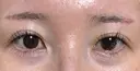 眉下切開 ノエル銀座クリニック DAY 49 サムネイル用