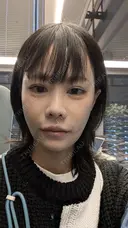 糸リフト / 脂肪吸引（顔） / その他（輪郭） / ジョールファット除去 WOM CLINIC GINZA （ワム クリニック ギンザ） DAY 7 サムネイル用