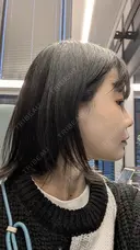 糸リフト / 脂肪吸引（顔） / その他（輪郭） / ジョールファット除去 WOM CLINIC GINZA （ワム クリニック ギンザ） DAY 7 サムネイル用