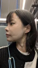 糸リフト / 脂肪吸引（顔） / その他（輪郭） / ジョールファット除去 WOM CLINIC GINZA （ワム クリニック ギンザ） DAY 7 サムネイル用