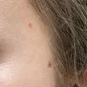 ほくろ・いぼ除去レーザー（肌） Fellez Clinic【フェルズクリニック】 DAY 10 サムネイル用