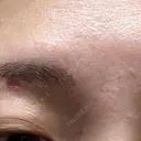 ほくろ・いぼ除去レーザー（肌） Fellez Clinic【フェルズクリニック】 DAY 10 サムネイル用