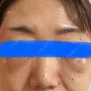 クマ治療 / 脂肪注入（輪郭） eクリニック 大阪梅田 西日本統括院 DAY 1 サムネイル用