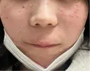ピコレーザートーニング（美白・肝斑） / ピコスポット 東京シルククリニック 新宿院 DAY 0 サムネイル用