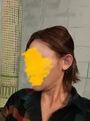 糸リフト / 脂肪吸引（顔） / ジョールファット除去 RIVER CLINIC（リバークリニック） DAY 18 サムネイル用