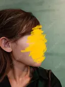 糸リフト / 脂肪吸引（顔） / ジョールファット除去 RIVER CLINIC（リバークリニック） DAY 18 サムネイル用