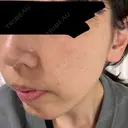 ピーリング（ニキビ・毛穴） / ルメッカ 大美会クリニック 梅田院 AFTER サムネイル用