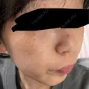 ピーリング（ニキビ・毛穴） / ルメッカ 大美会クリニック 梅田院 DAY 9 サムネイル用