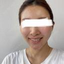 糸リフト / 脂肪吸引（顔） / 額を丸く / 脂肪注入（額） / ジョールファット除去 / 脂肪吸引注射（顔） / 脂肪注入（輪郭） / 美容点滴・美容注射（疲労回復） / その他 SEA CLINIC（シークリニック） DAY 30 サムネイル用