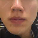イオン導入 Kinshicho Beauty Clinic （錦糸町ビューティークリニック） DAY 1 サムネイル用