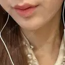 ヒアルロン酸注入（あご） HAAB×DREAM BEAUTY CLINIC 大阪梅田院 AFTER サムネイル用