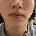 イオン導入 Kinshicho Beauty Clinic （錦糸町ビューティークリニック） DAY 2 サムネイル用