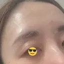 ボトックス（あご） / ボトックス（口角） / ボトックス（眉間） / ボトックス（額） / ボトックス（バニーライン） / その他（鼻） TCB東京中央美容外科 札幌駅前院 DAY 15 サムネイル用