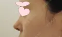 鼻中隔延長（切開） / 小鼻縮小（切開） / 軟骨移植 / 骨切幅寄せ / 鼻尖縮小 HANABI整形外科 DAY 7 サムネイル用