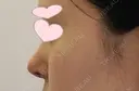 鼻中隔延長（切開） / 小鼻縮小（切開） / 軟骨移植 / 骨切幅寄せ / 鼻尖縮小 HANABI整形外科 DAY 9 サムネイル用