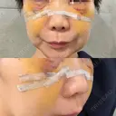 クマ治療 池袋麗歯科・美容皮膚科 DAY 5 サムネイル用