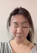 糸リフト / 脂肪吸引（顔） Wing clinic 豊中駅前院 DAY 2 サムネイル用