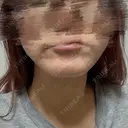 ボトックス（あご） / ボトックス（口角） DMTC CLINIC 渋谷院 AFTER サムネイル用