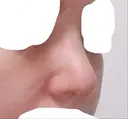 鼻尖形成（切開） / 鼻中隔延長（切開） / 骨切幅寄せ 韓国BBクリニック（旧 シンミアン形成外科） DAY 7 サムネイル用