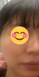 ボトックス（あご） / ボトックス（エラ・小顔） / シワ取りボトックス / ボトックス（眉間） LE CLINIC AFTER サムネイル用