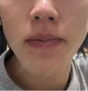 イオン導入 Kinshicho Beauty Clinic （錦糸町ビューティークリニック） DAY 4 サムネイル用