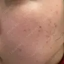 ルメッカ ルラ美容クリニック 郡山院 AFTER サムネイル用