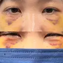 クマ治療 池袋麗歯科・美容皮膚科 DAY 7 サムネイル用