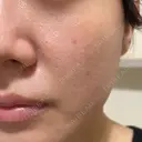 ヴェルヴェットスキン 形成外科と美容外科のクリニック池袋 DAY 6 サムネイル用