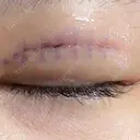 二重埋没 / 自然癒着法 形成外科と美容外科のクリニック池袋 DAY 0 サムネイル用