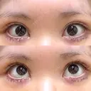 タレ目形成・グラマラスライン（切開） 形成外科と美容外科のクリニック池袋 DAY 7 サムネイル用