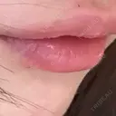ヒアルロン酸注入（唇） Moon Beauty Clinic AFTER サムネイル用