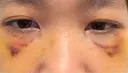 クマ治療 池袋麗歯科・美容皮膚科 DAY 8 サムネイル用
