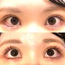 タレ目形成・グラマラスライン（切開） 形成外科と美容外科のクリニック池袋 DAY 8 サムネイル用