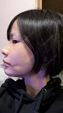 糸リフト / 脂肪吸引（顔） / その他（輪郭） / ジョールファット除去 WOM CLINIC GINZA （ワム クリニック ギンザ） DAY 14 サムネイル用