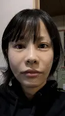 糸リフト / 脂肪吸引（顔） / その他（輪郭） / ジョールファット除去 WOM CLINIC GINZA （ワム クリニック ギンザ） DAY 14 サムネイル用