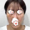 肌ヒアルロン酸注入（たるみ・シワ改善） しのぶ皮膚科 DAY 9 サムネイル用